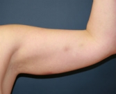 Feel Beautiful - Liposuction left arm - Before Photo
